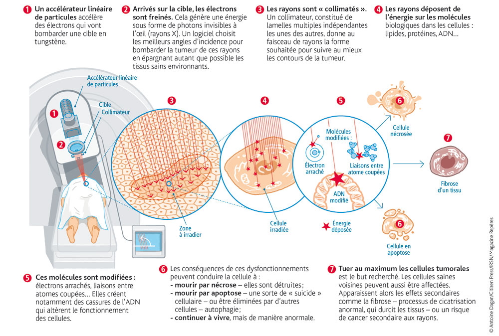 Infographie : l'action des rayonnements ionisants en radiothérapie