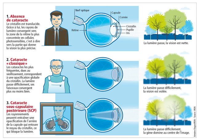 Quels sont les effets des rayonnements sur le cristallin 