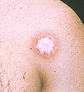 D&eacute;pigmentation avec halo d&rsquo;hyperpigmentation