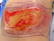 Desquamation humide &agrave; 3 mois post-irradiation
