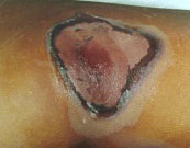 Evolution &agrave; 1 mois : desquamation humide avec halos d&rsquo;hyper et d&rsquo;hypopigmentation